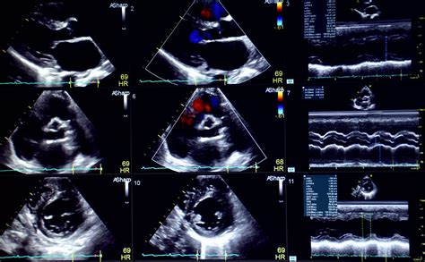 Echocardiogram (Echo) .
